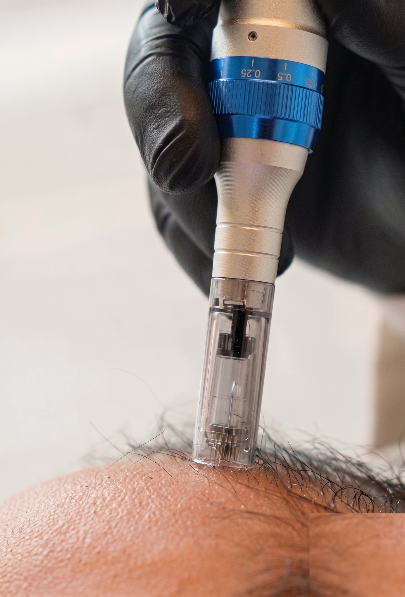 Macro do Choi Implanter: mão enluvada em luva preta segurando a caneta aplicadora com folículo capilar visível no compartimento transparente, escala de profundidade '0.25 0.5' visível, área tratada no couro cabeludo.